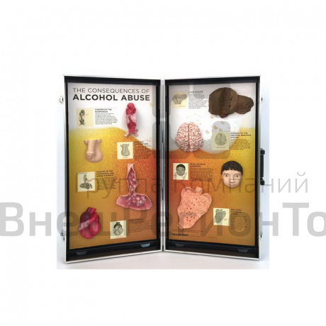 Объемный стенд Последствия алкоголизма.