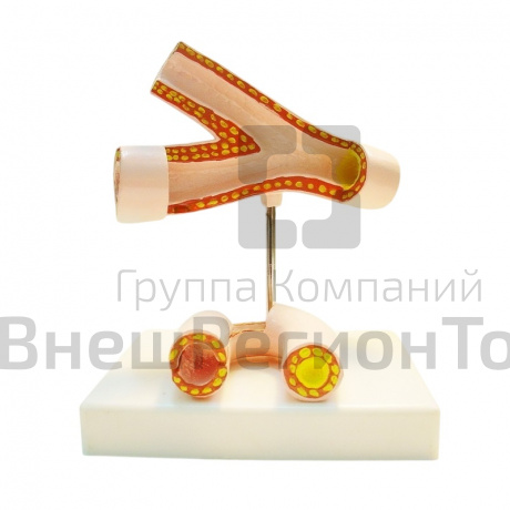 Модель "Здоровые и поврежденные сосуды".