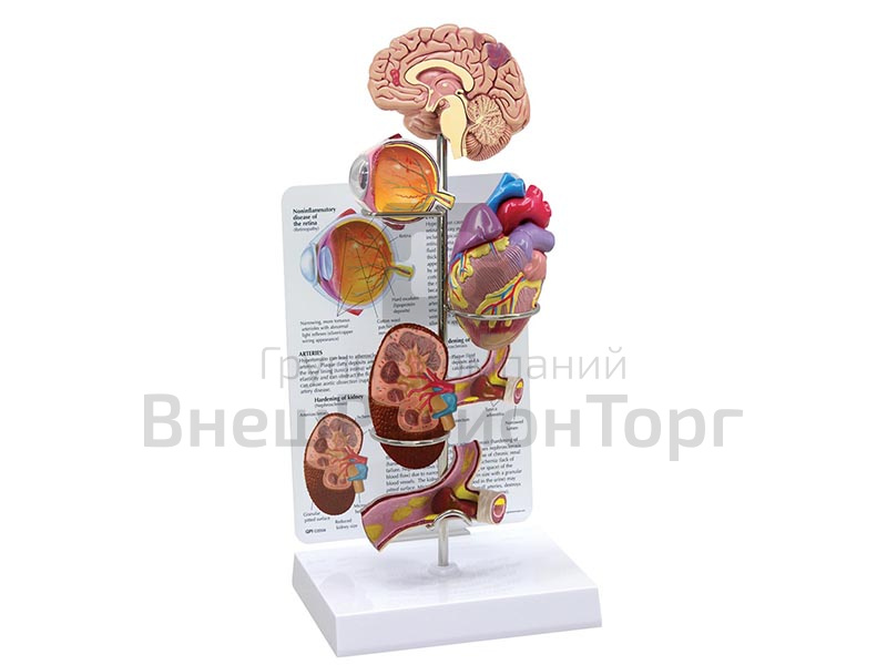 Комплект Гипертония.